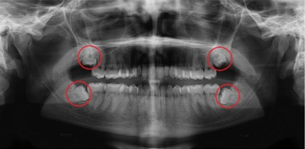 Impacted Wisdom Teeth Types And Removal Bond Street Dental